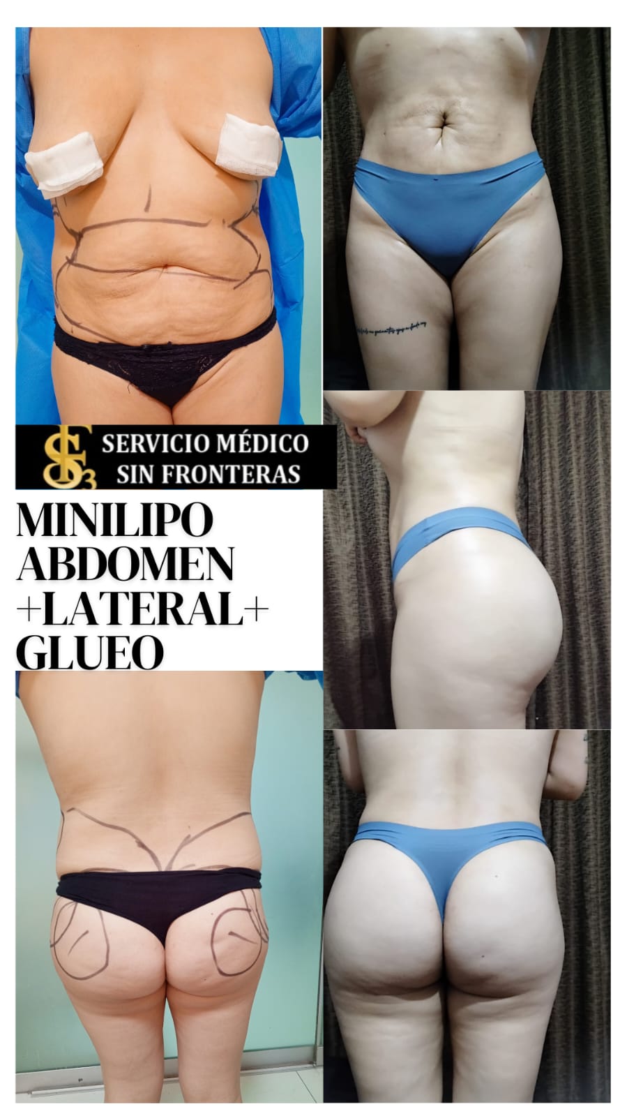 Resultado Lipo 360 4